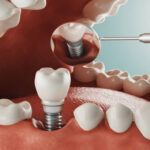 Single vs multiple dental implants Lewisburg